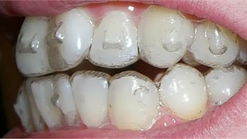 Invisalign Attachments