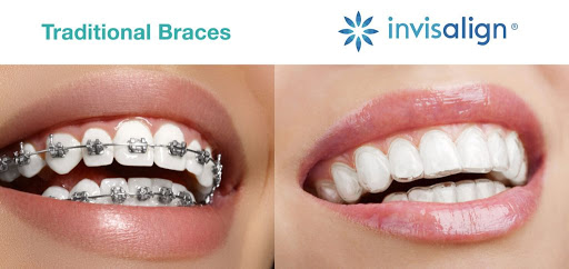 Ceramic Braces vs. Invisalign - Orthodontics in Timonium, MD